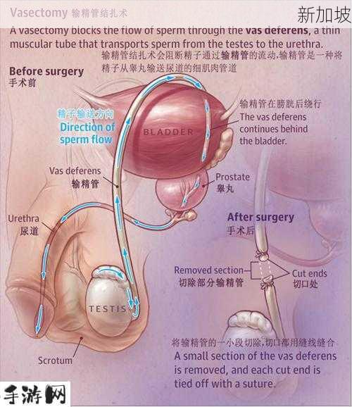 tubectomy vasectomy：结扎手术对男女健康有哪些影响？