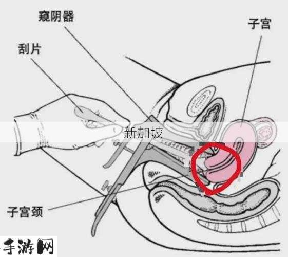 专家解析：14厘米长物品能否安全进入宫颈及相关宫颈问题